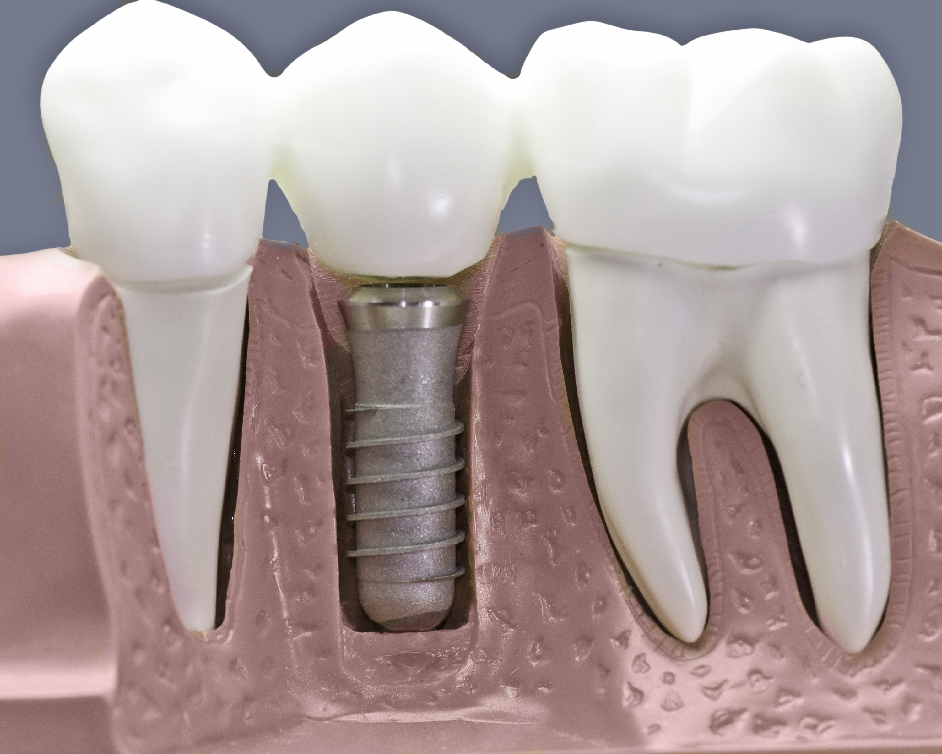 Dental Implants Parker CO